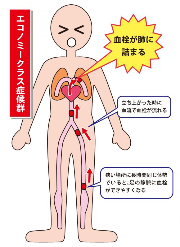 エコノミークラス症候群