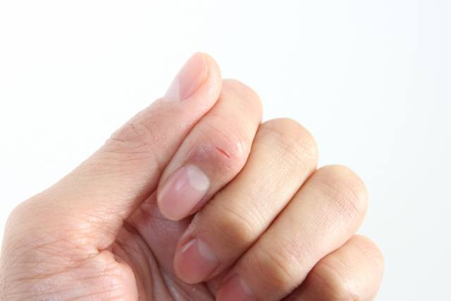 手や指のひび割れの原因や治療は ハンドクリーム ステロイドの効果は くらしの豆知識